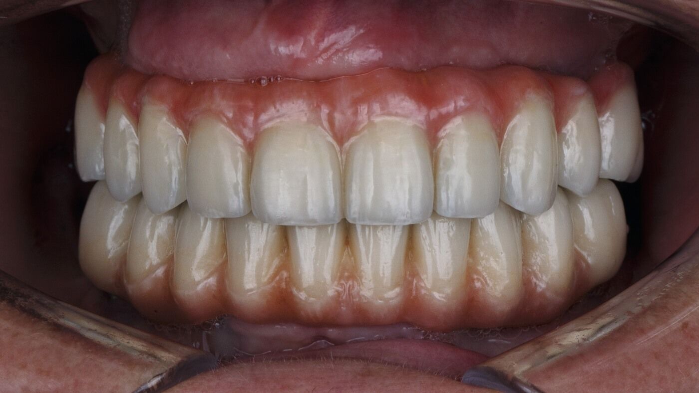 фото зубов пациента с протезом на имплантатах по методике All-on-4 | Все-на-4