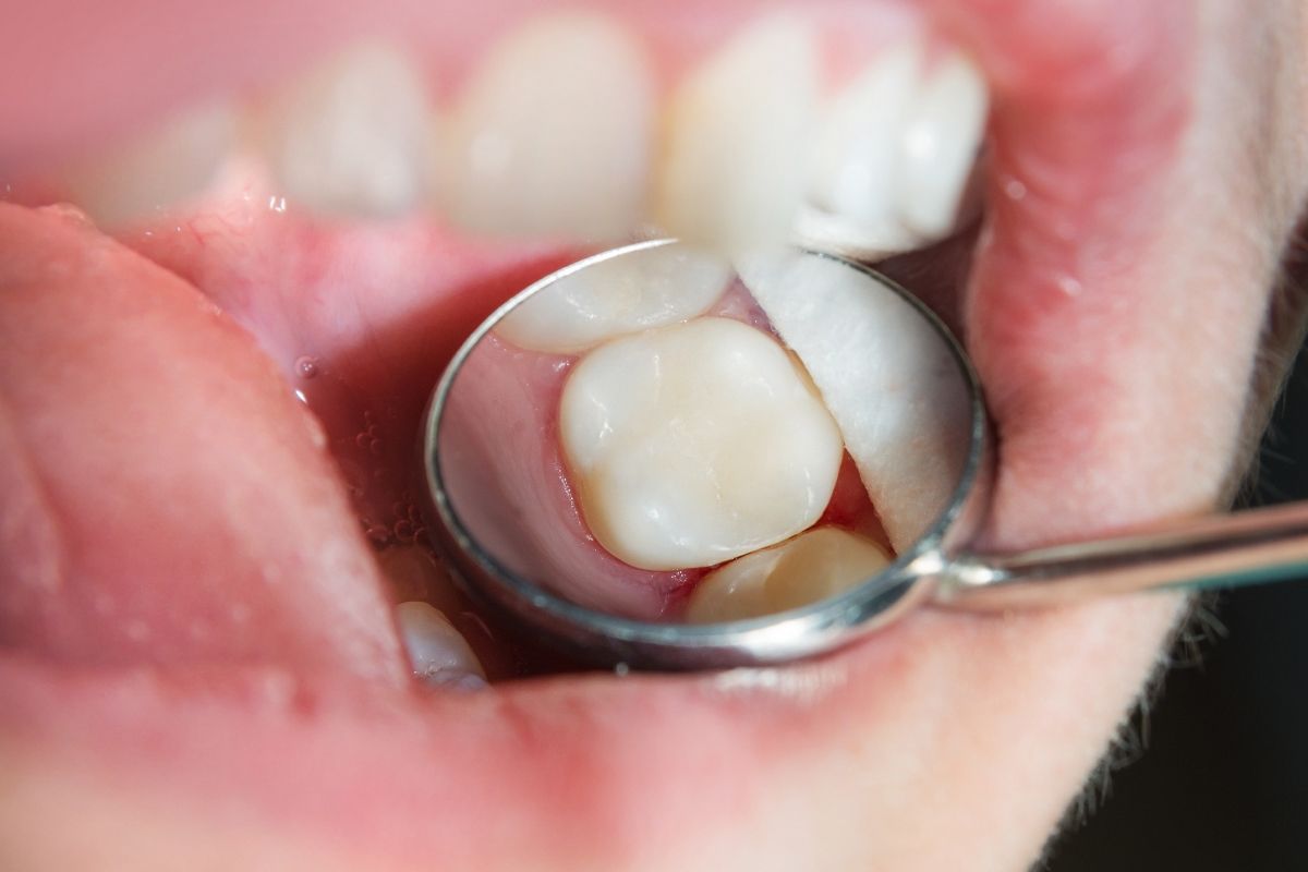 фото зубов после лечения кариеса