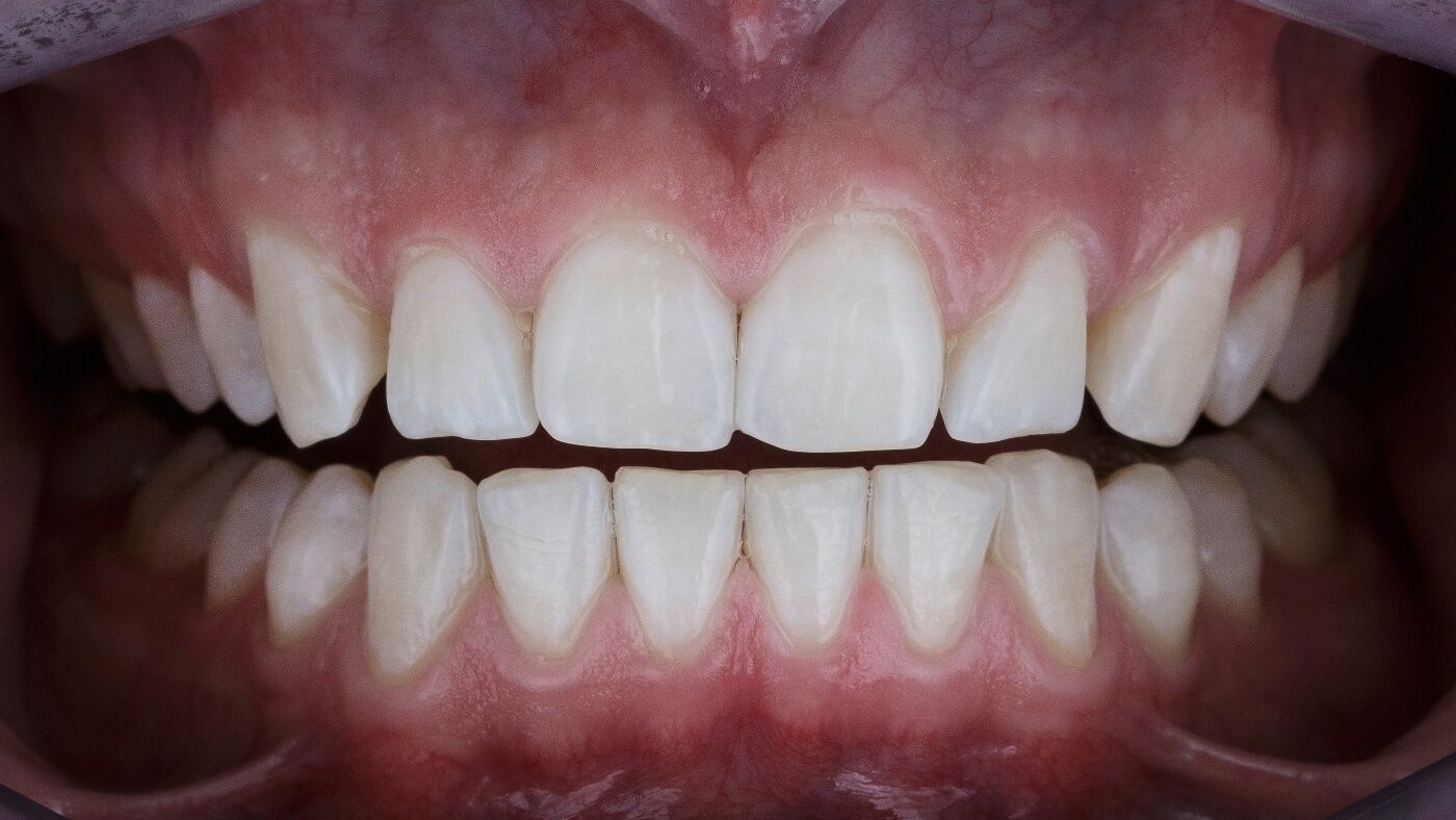 крупное фото зубов после отбеливания зубов