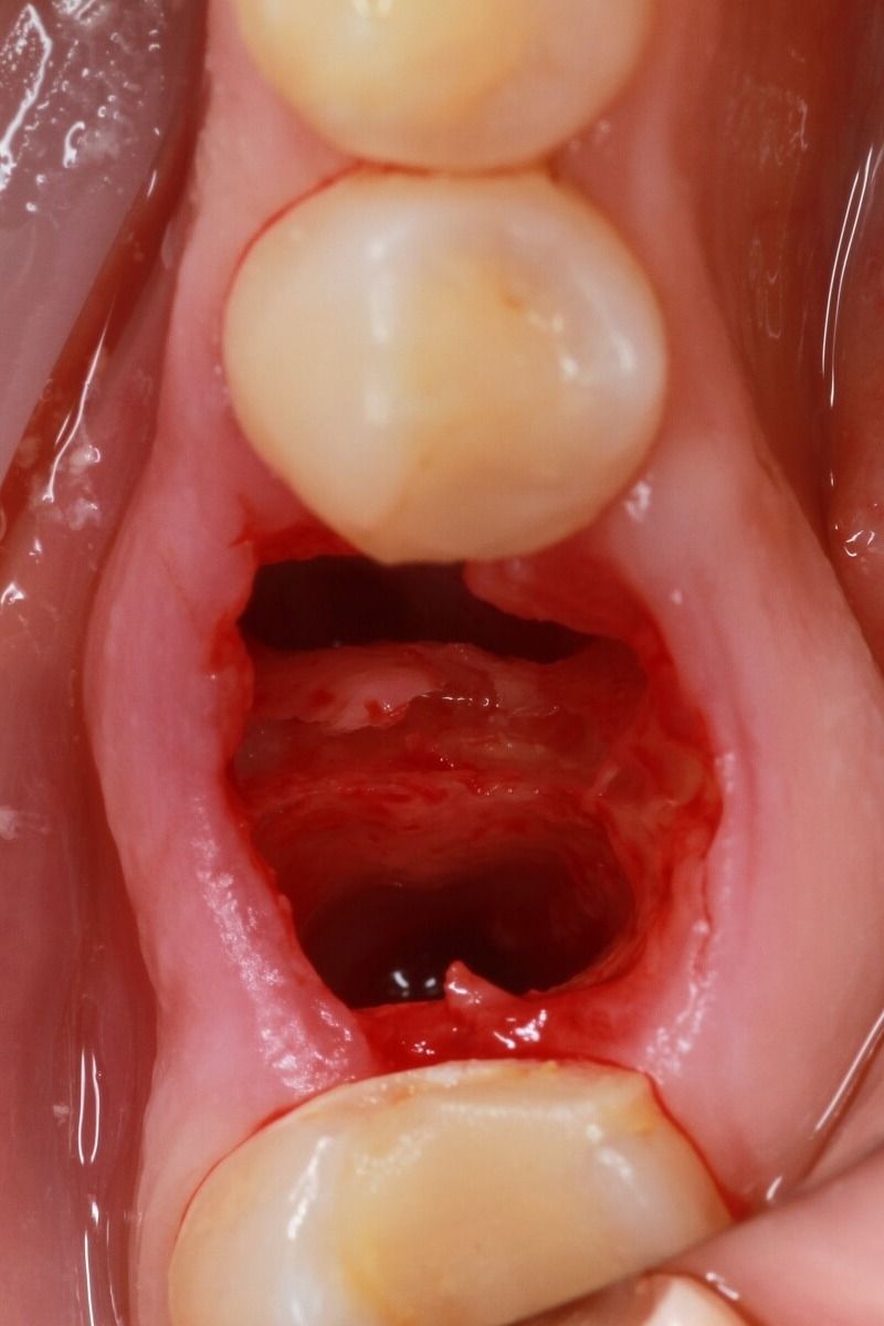 место удаленного зуба с установленным имплантатом и формирователем
