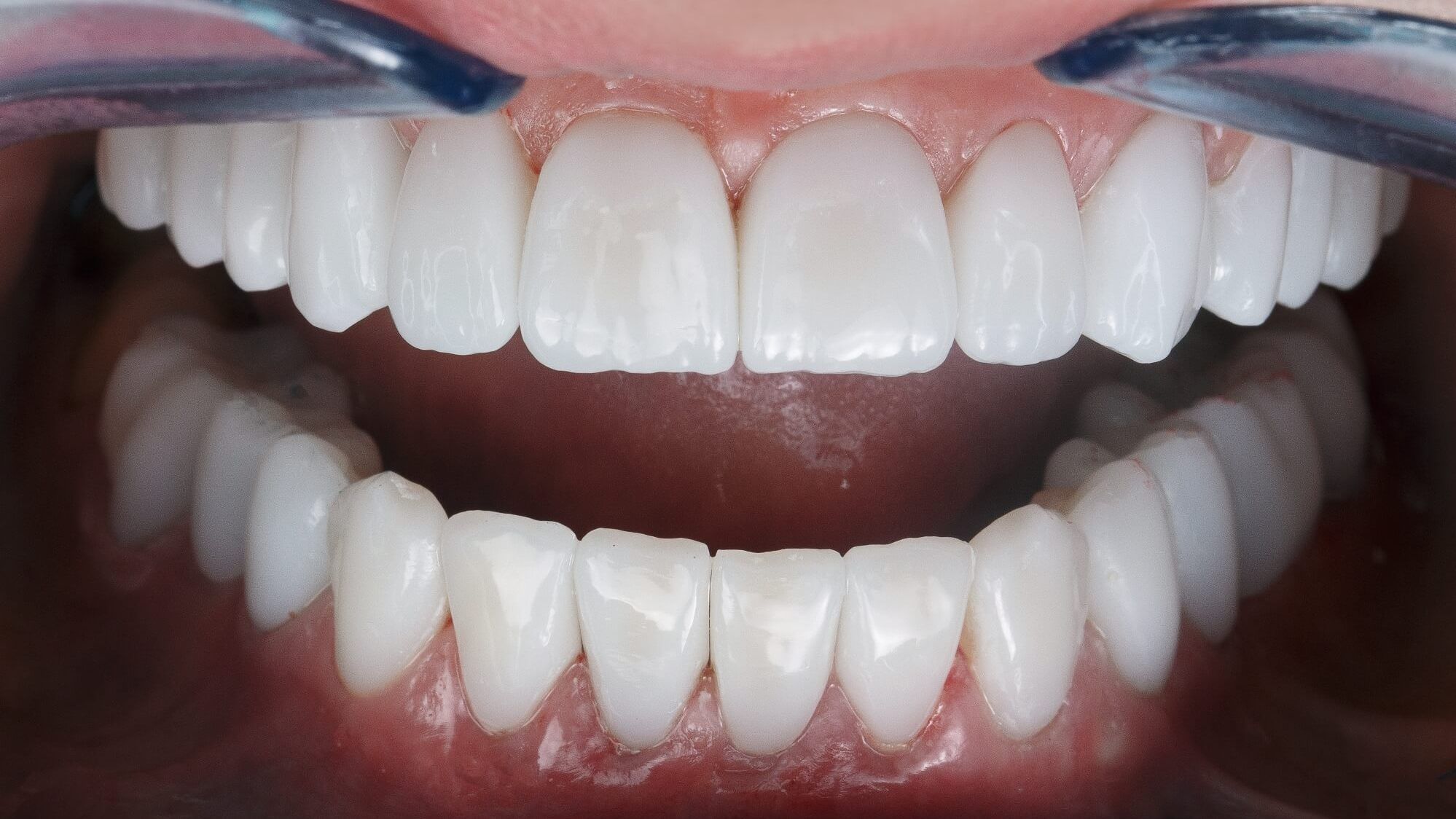 фото протезирования всех зубов циркониевыми коронками