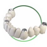 Фиксация временной челюсти обязательный этап операции по имплантации всех зубов All-on-4 | Все-на-4