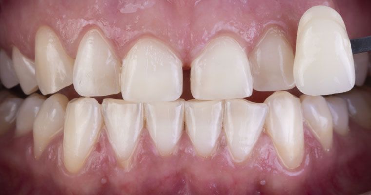 зубы пациента после отбеливания зубов