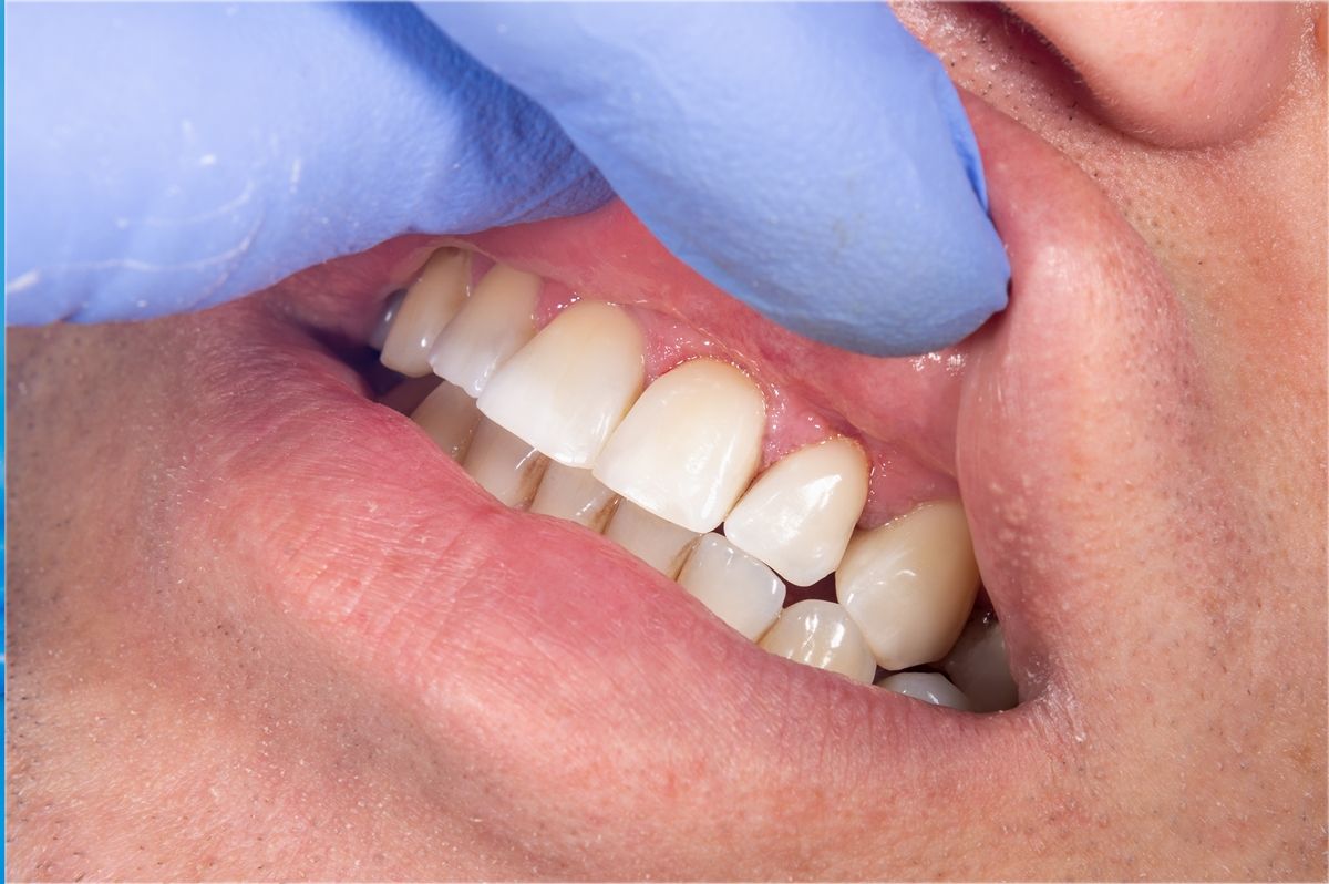 зубы пациента после реставрации