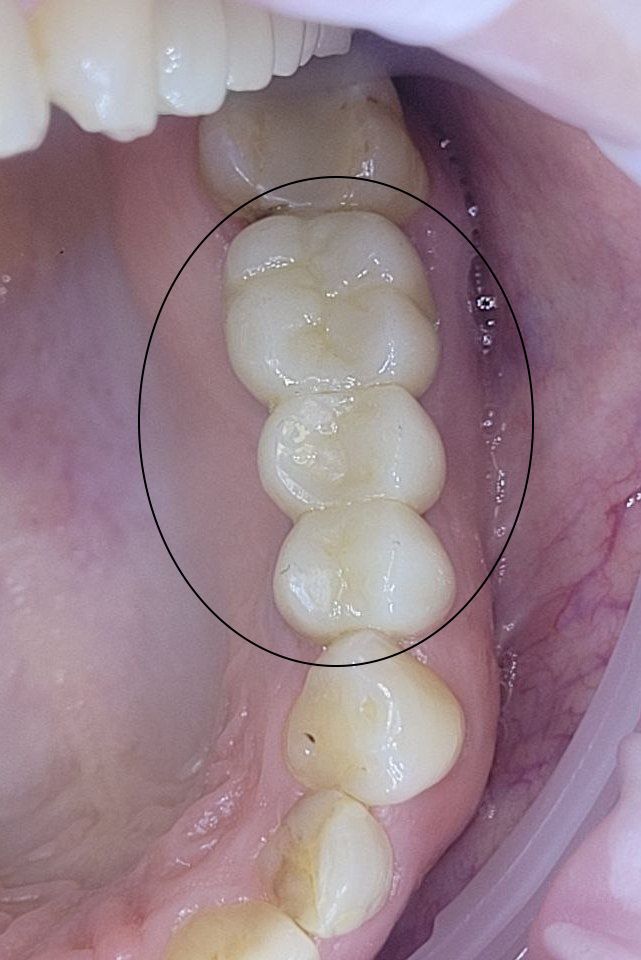имплантация трех жевательных зубов