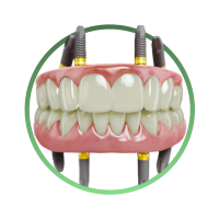 имплантация и протезирование всех зубов All-on-4 | Все-на-4