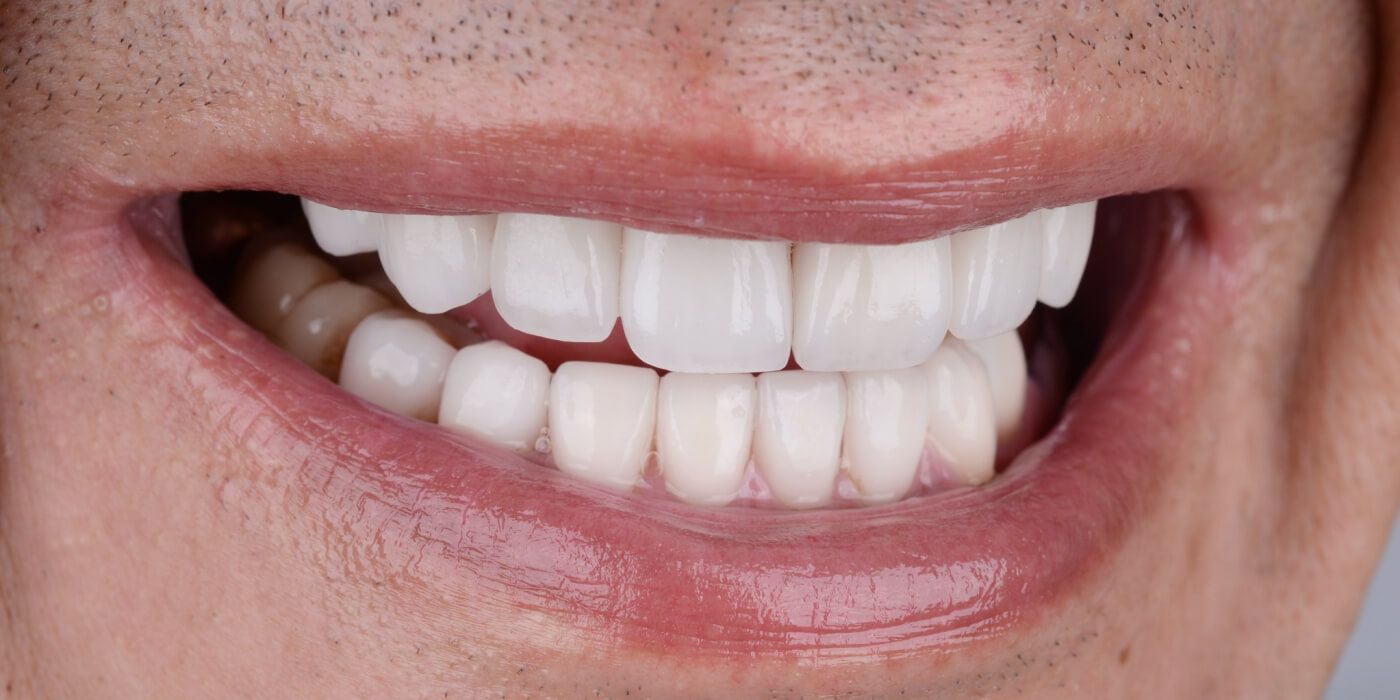 мужская улыбка после протезирования зубов керамическими коронками