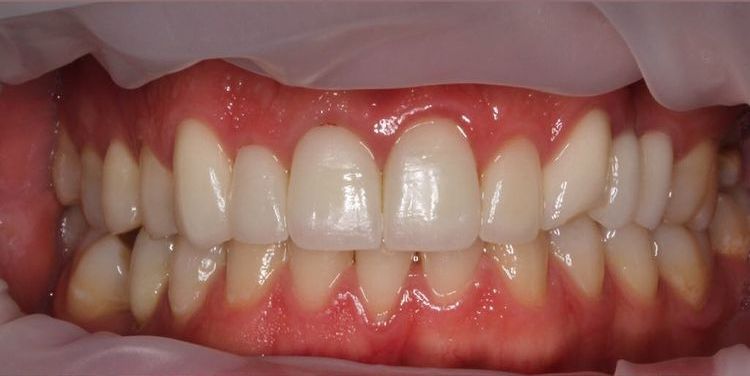 желтая эмаль зубов до отбеливания зубов