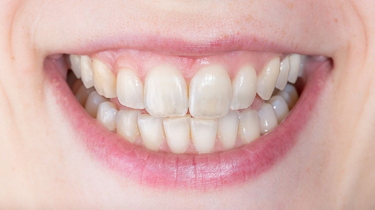 фото зубов пациента который следит за гигиеной зубов