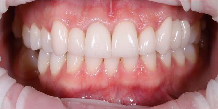 белая эмаль зубов после отбеливания зубов