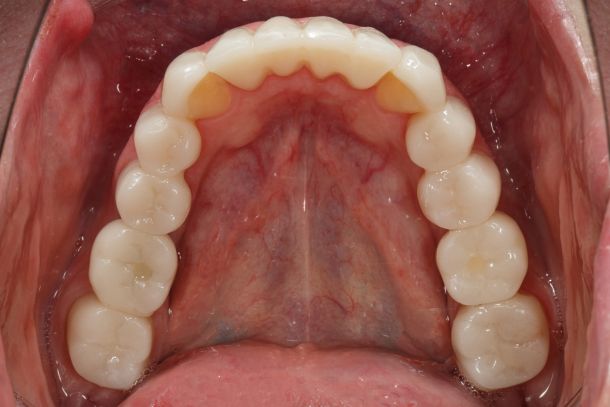 фото полости рта пациента после имплантации зубов