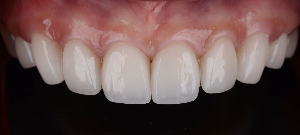 зубы пациента после установки керамических виниров