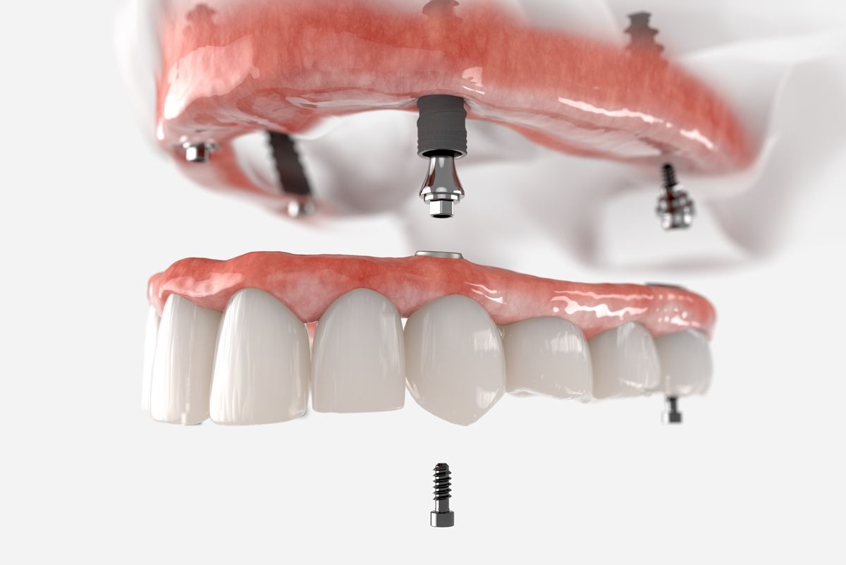 стоимость протезирования всех зубов с опорой на имплантаты