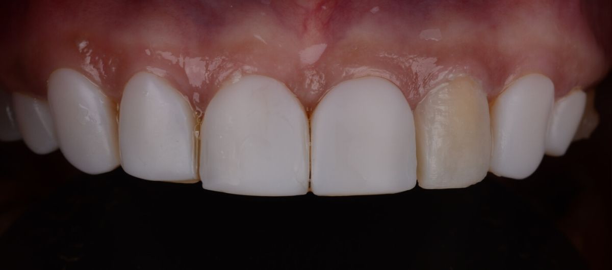 зубы пациента до установки керамических виниров