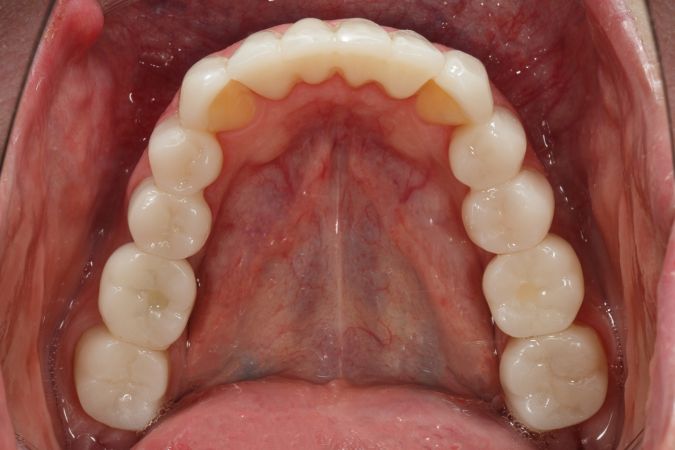 Зубы пациента после лечения, имплантации и протезирования