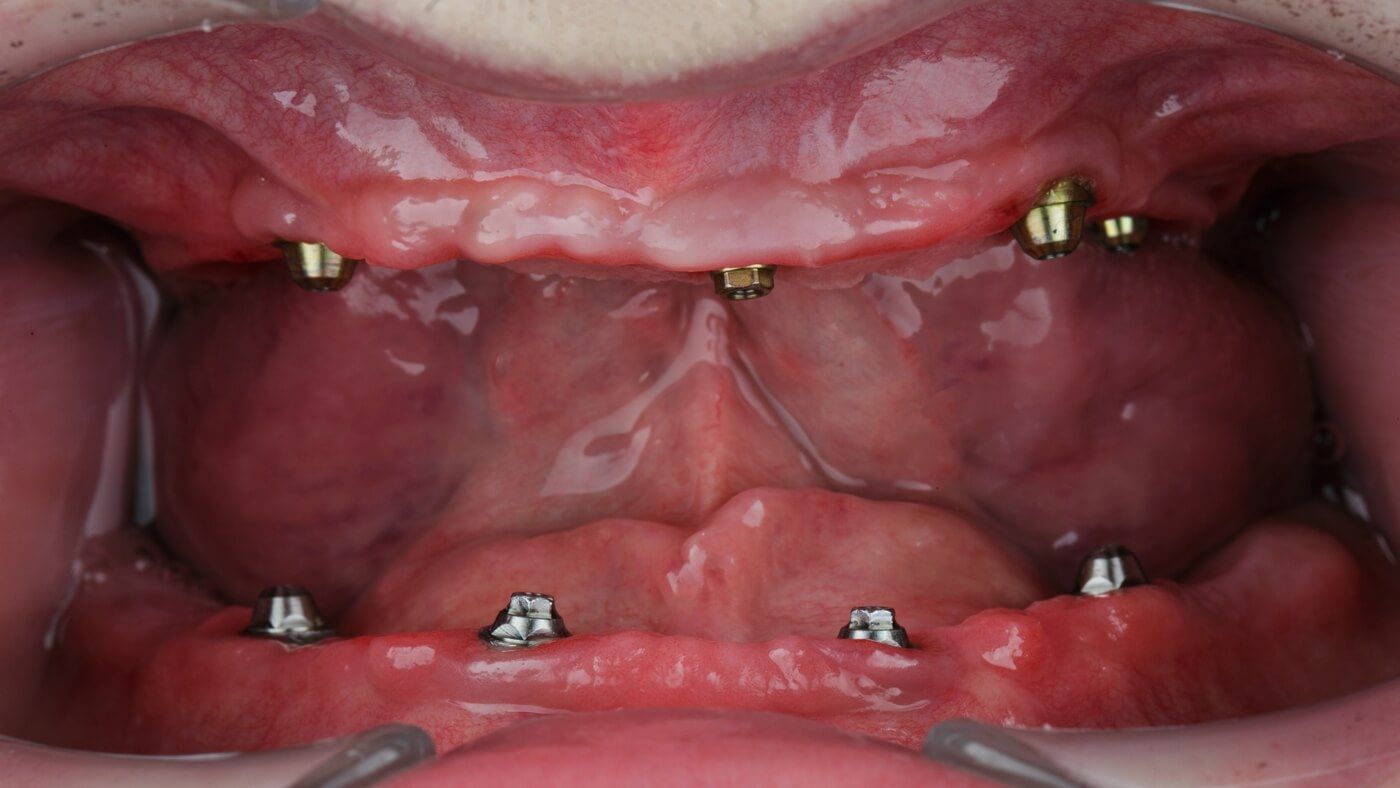 фото полости пациента до имплантации всех зубов