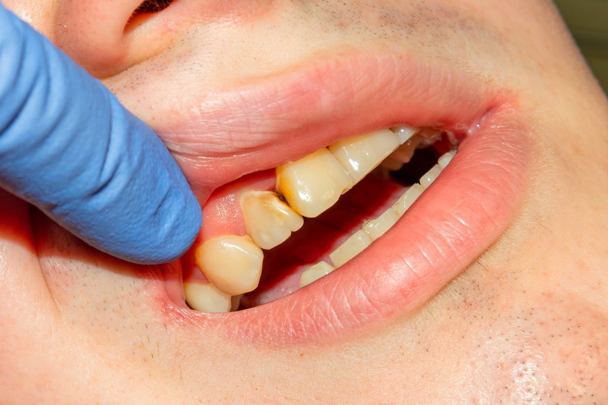 фото передних зубов нуждающихся в реставрации стоматологом