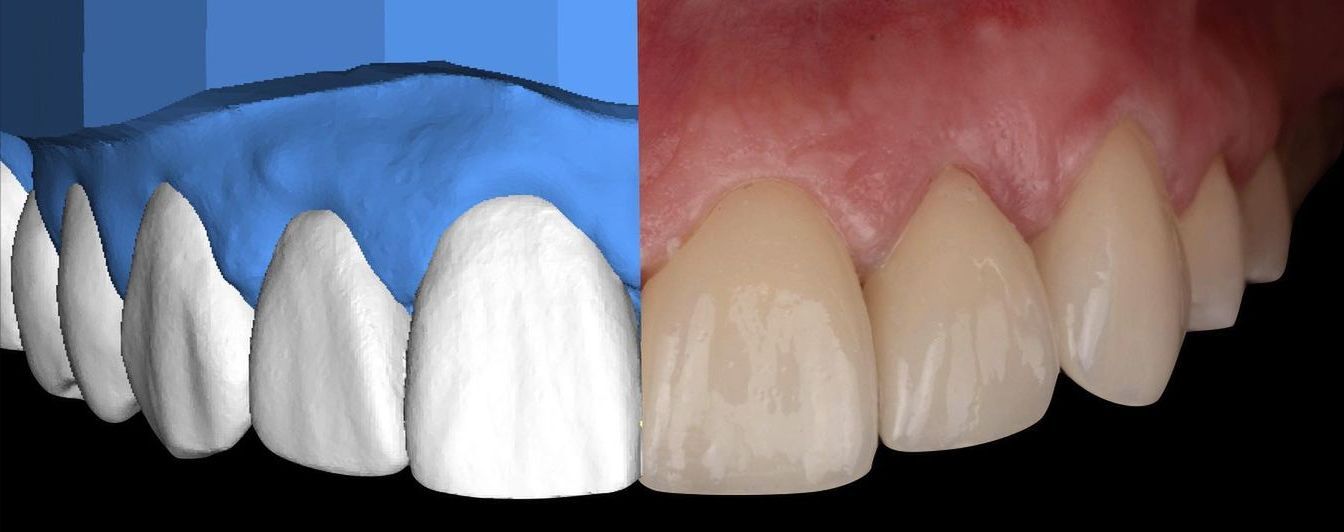 цифровой проект и фото после протезирования зубов