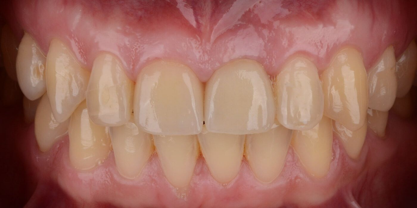 ситуация в полости рта после протезирования передних зубов