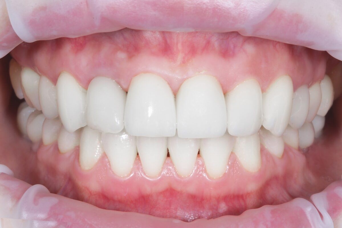 После имплантации переднего зуба с увеличением мягких тканей