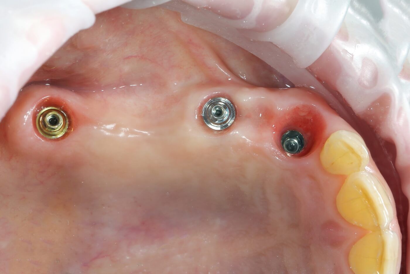 фото полости рта до протезирования жевательных зубов