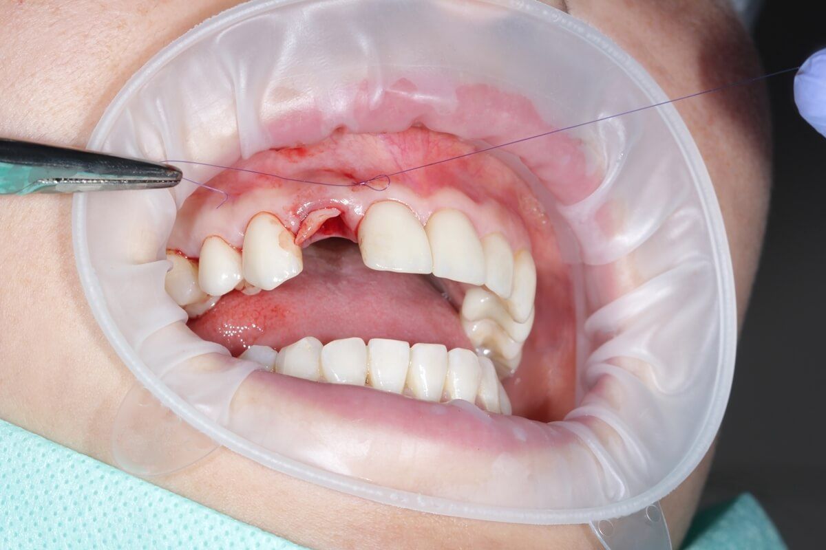 Пластика десны в области имплантации переднего зуба