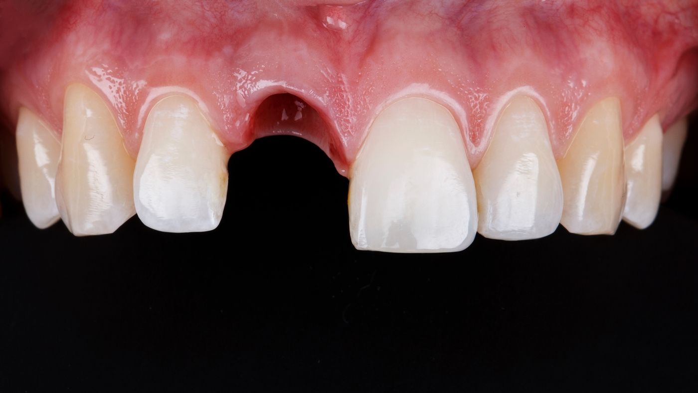 фото до имплантации переднего зуба в стоматологии Ковальский