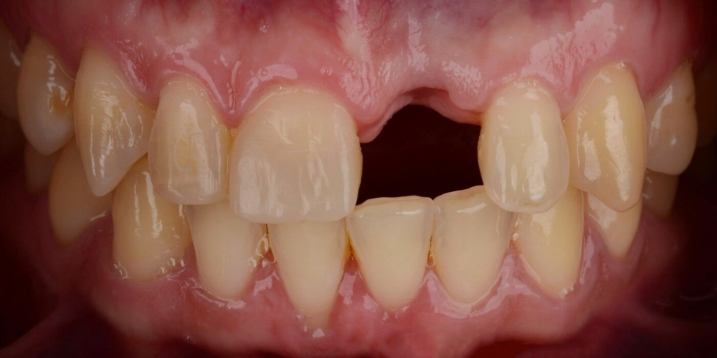 ситуация в полости рта до протезирования передних зубов