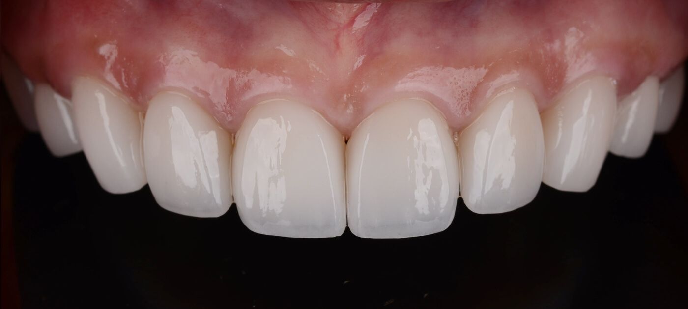 фото пациента после протезирование зубов керамическими коронками