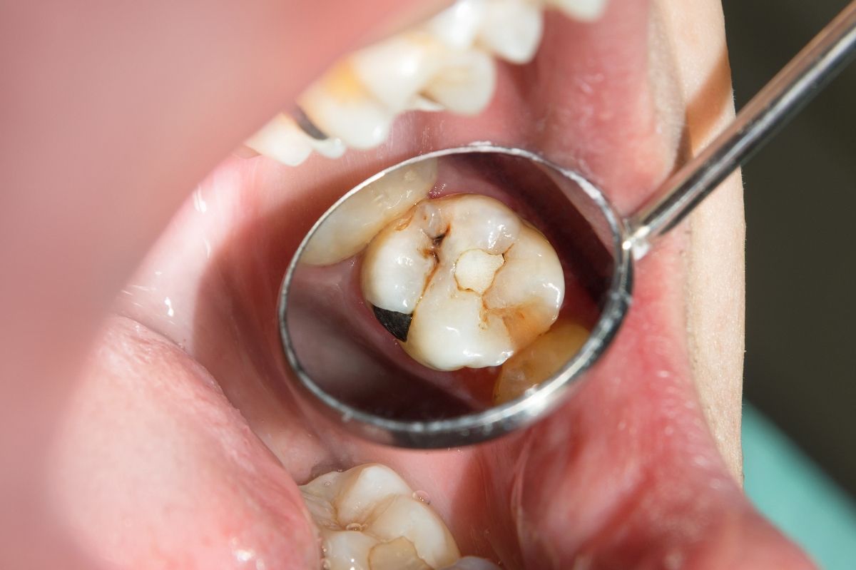 фото зубов до лечения кариеса