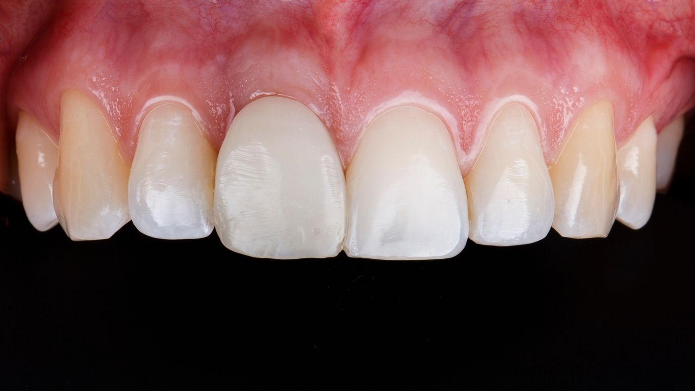 фото после имплантации переднего зуба в стоматологии Ковальский
