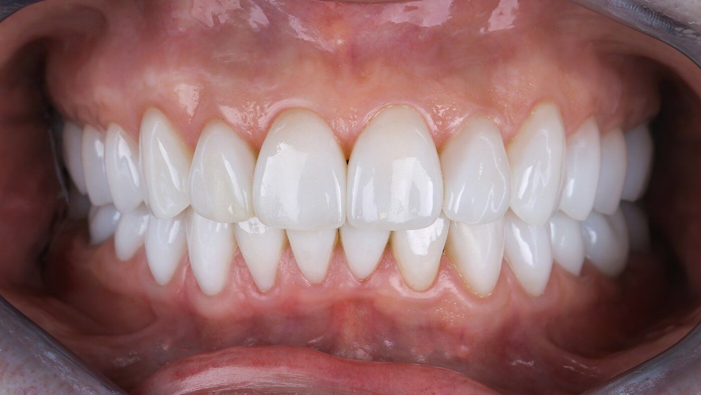 фото протезирования всех зубов керамическими коронками