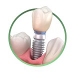 имплантация зубов в стоматологической клинике Dr Kovalskii