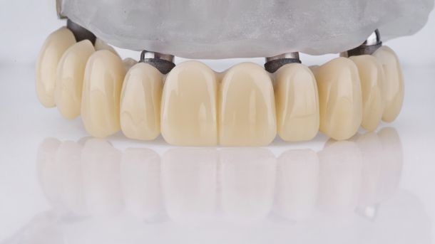 зубной протез для протезирования всех зубов на имплантатах