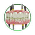 Протезы зубов с опорой на дентальные имплантаты