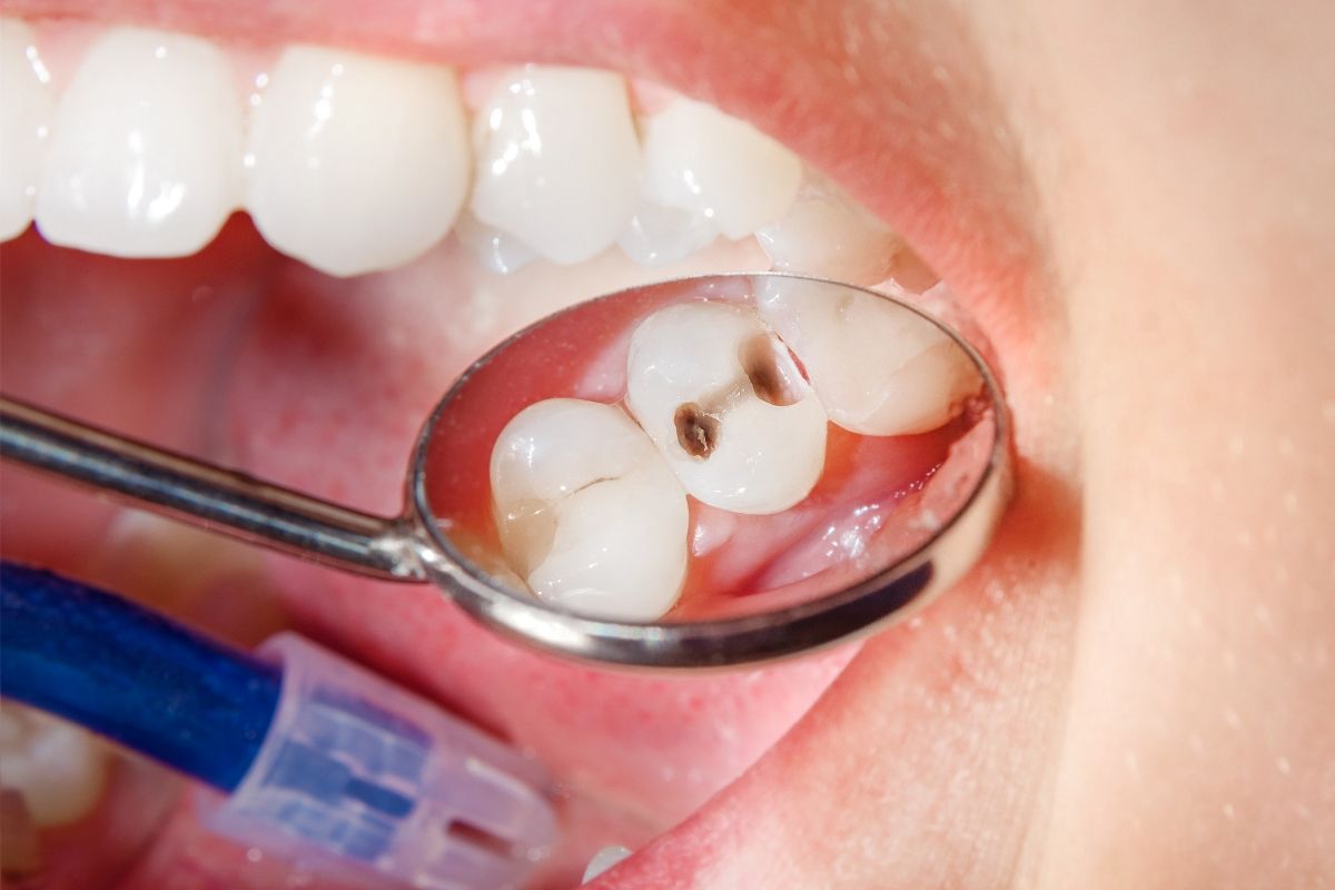 фото 5-го зуба до лечения кариеса