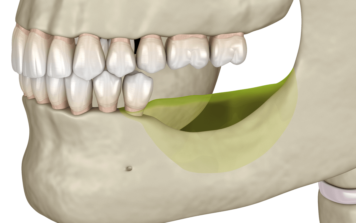 иллюстрация операции по костной пластике на нижней челюсти