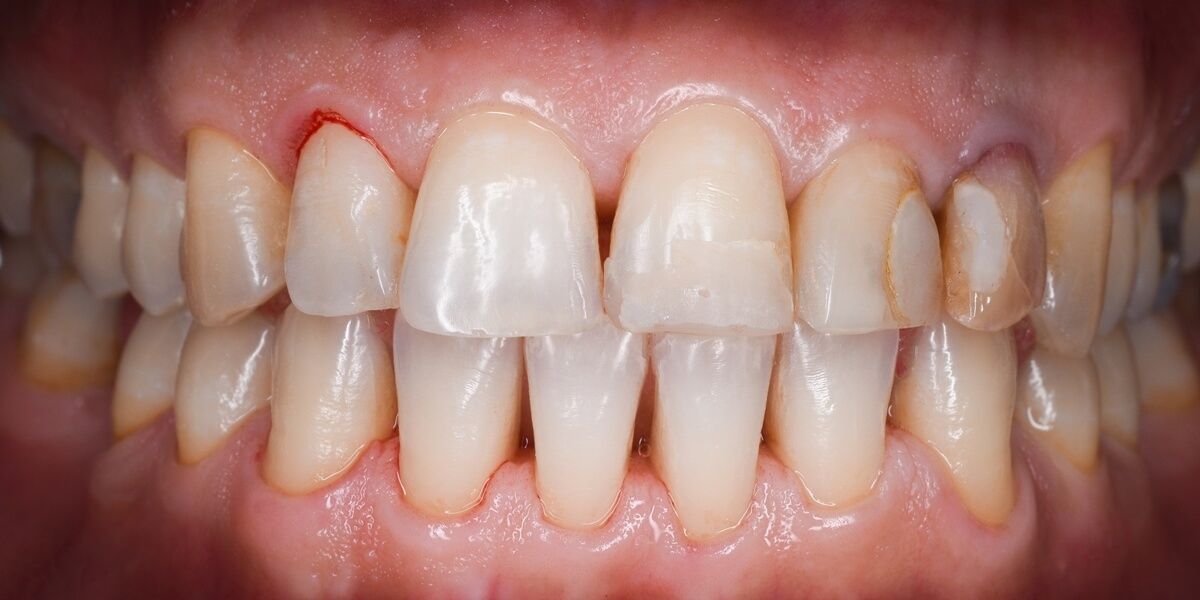 фото зубов без налета после профессиональной чистки зубов