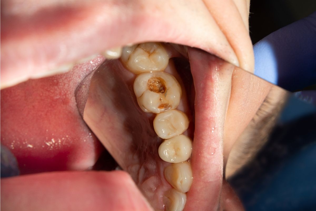 фото зубов до лечения пульпита