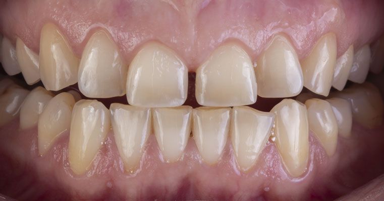 зубы пациента до отбеливания зубов