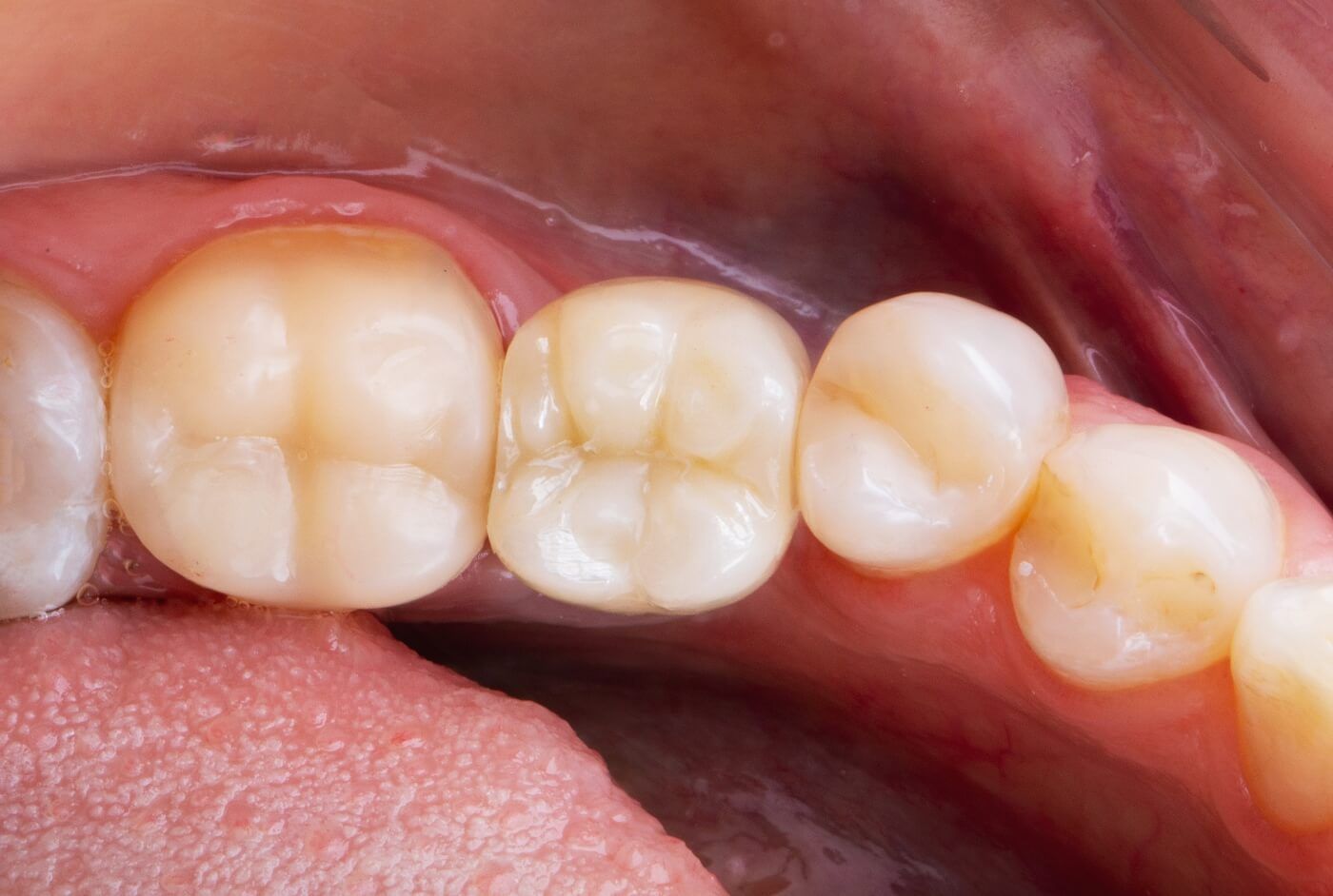 фото зубов после имплантации 1 зуба