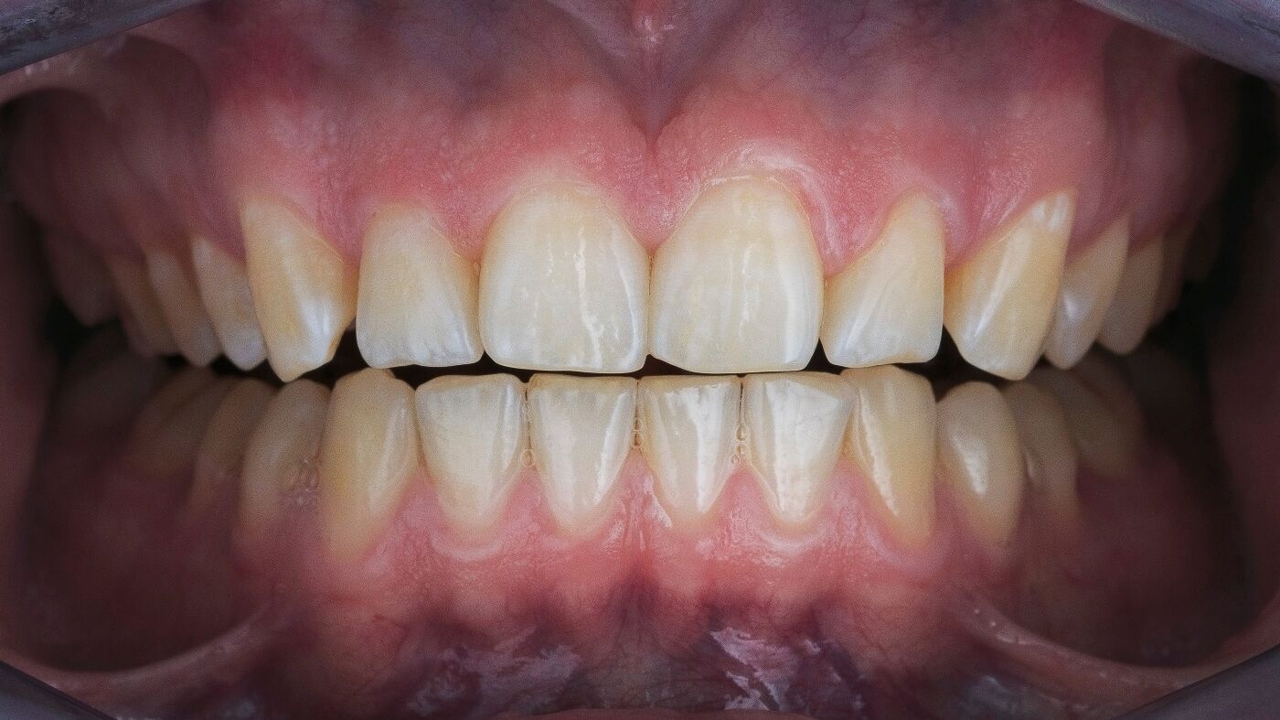 крупное фото зубов до отбеливания зубов