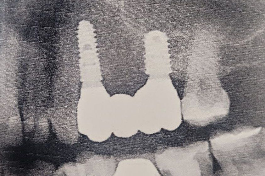 рентгеновский снимок установленных имплантатов с мостом