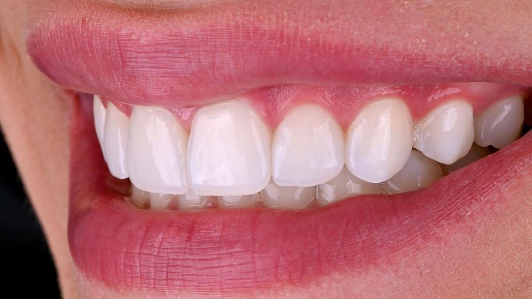 фото виниров после протезирования зубов
