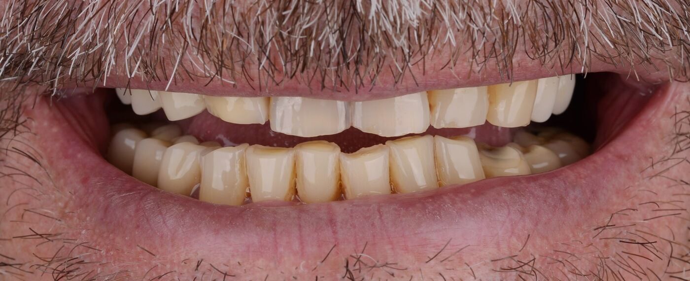 зубы пациента до фиксации керамических виниров