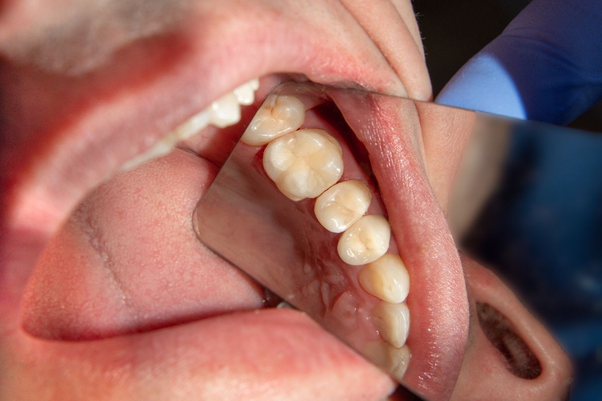 фото зубов после лечения под микроскопом