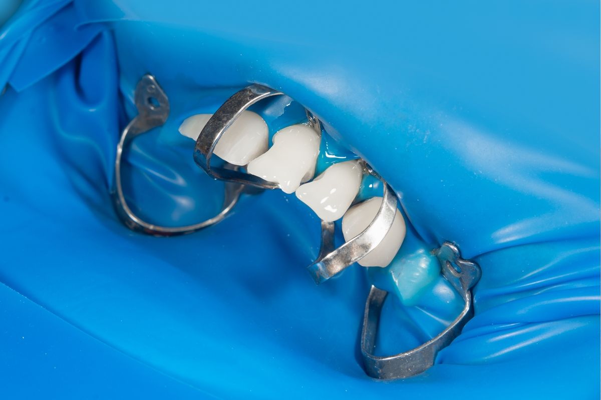 фото зубов во время лечения кариеса 