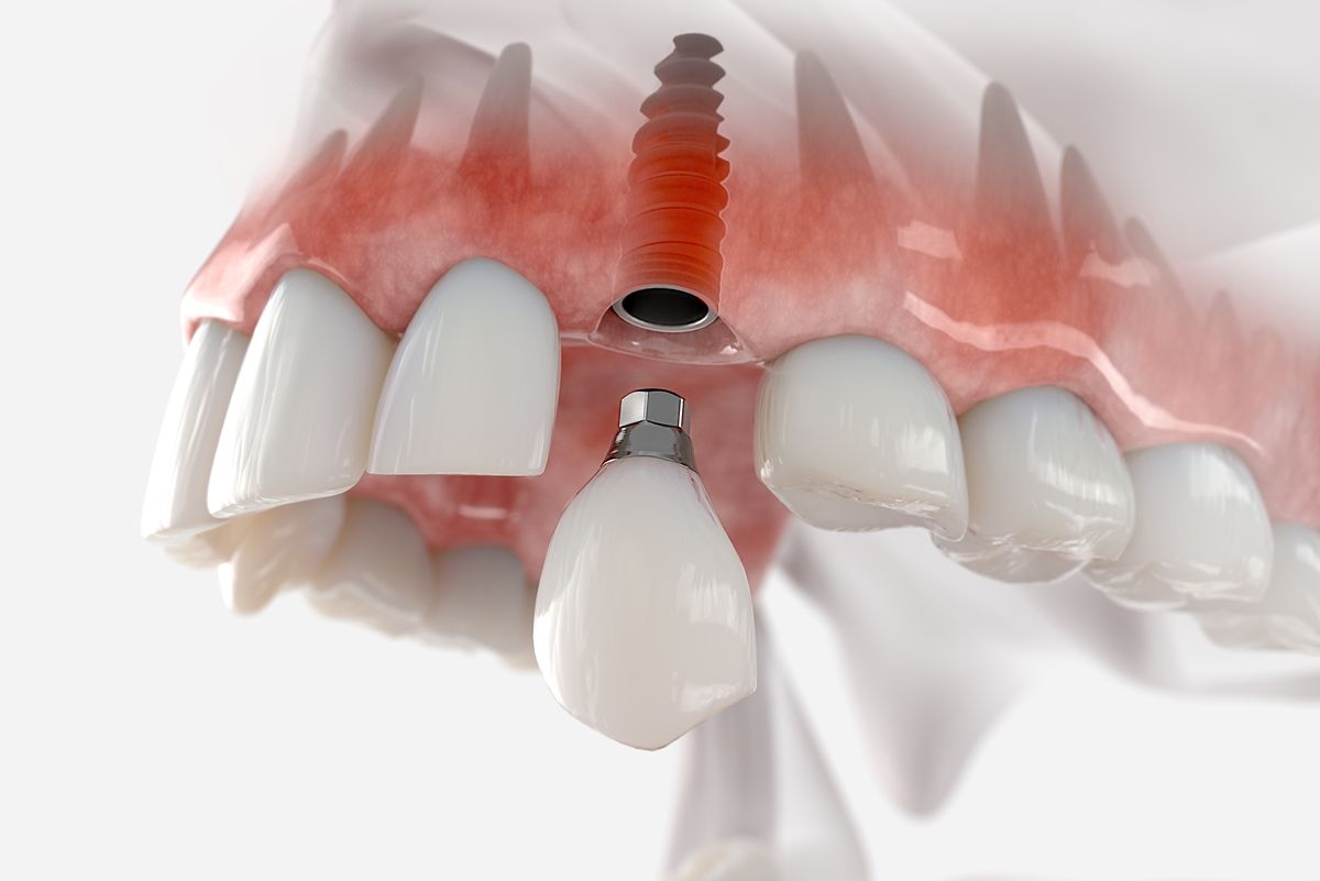 стоимость протезирование переднего зуба с опорой на дентальные имплантаты