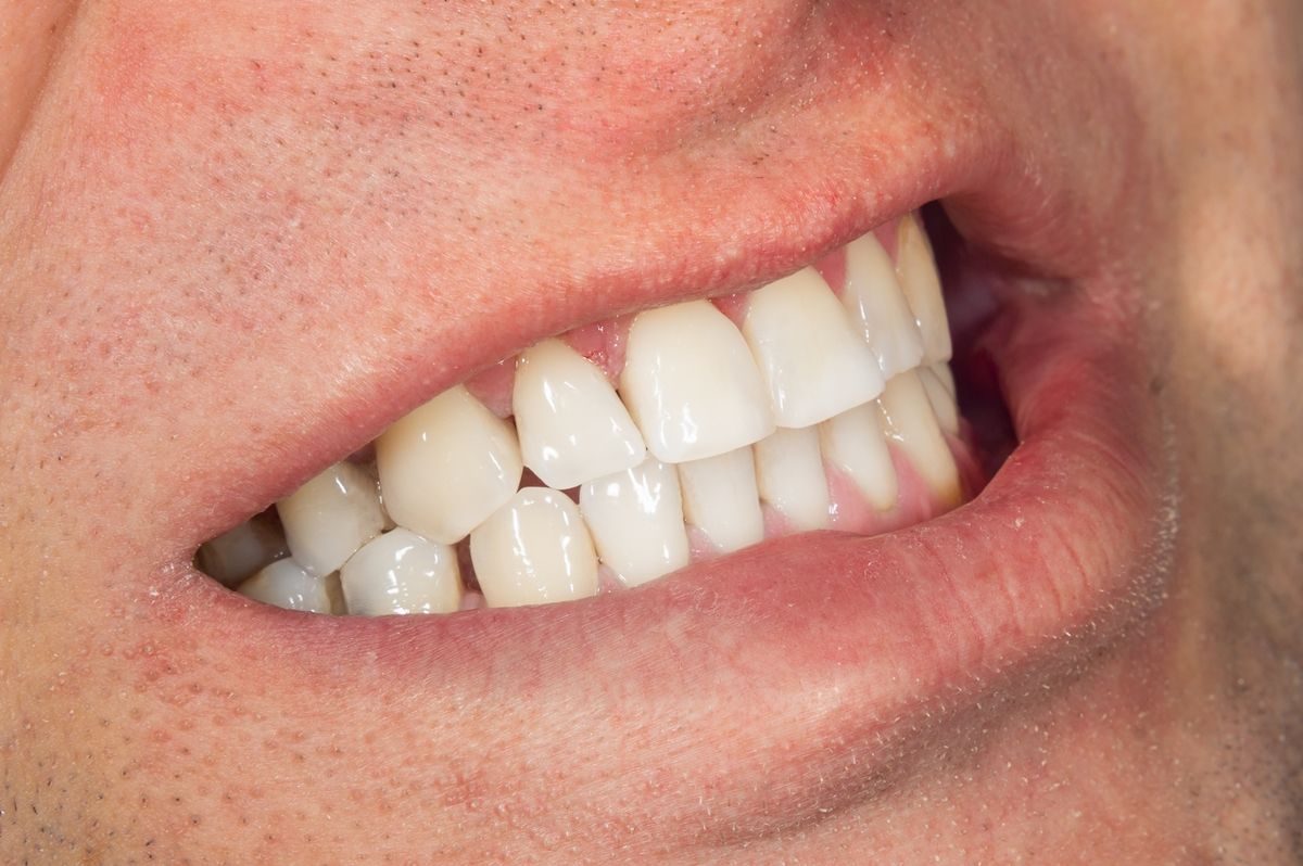 фото зубов после проф. чистки и отбеливания